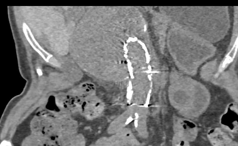 Endoleak s/p Stent Placement in 3D - CTisus CT Scan