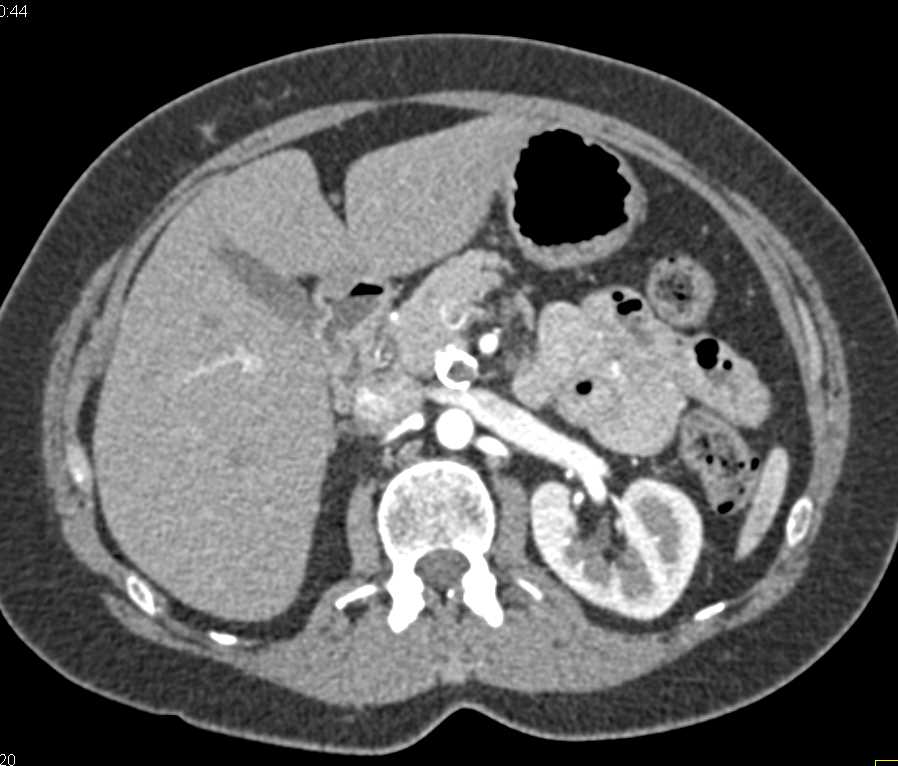 Calcified Aneurysm off the Superior Mesenteric Artery (SMA) - CTisus CT Scan