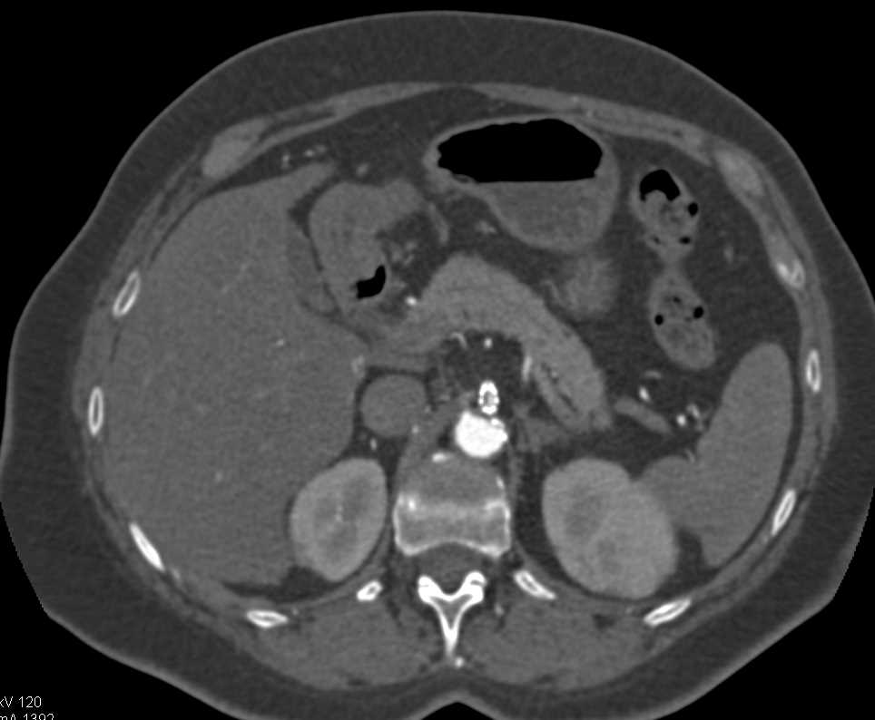 Stent in Superior Mesenteric Artery (SMA) and Stent is Patent - CTisus CT Scan