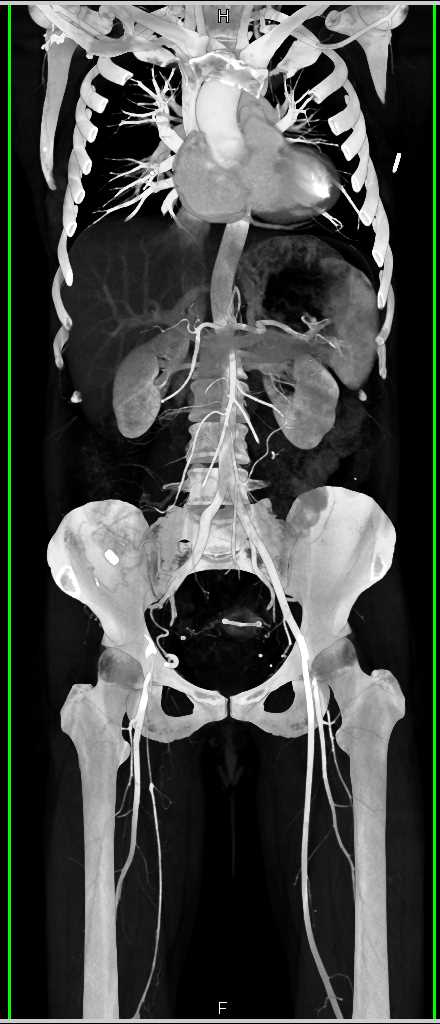 Occlusion of the Right External Iliac Artery with Collaterals - CTisus CT Scan