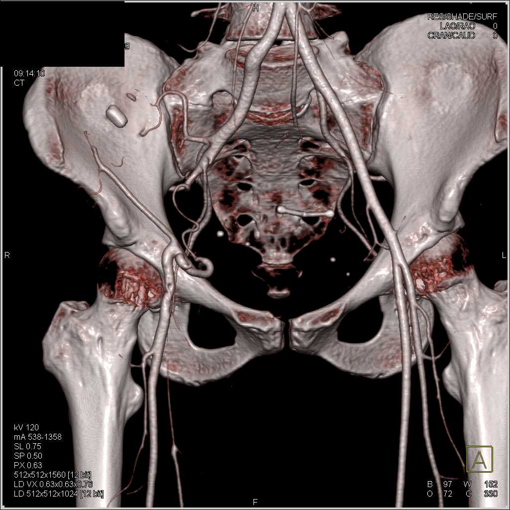 External Iliac Artery