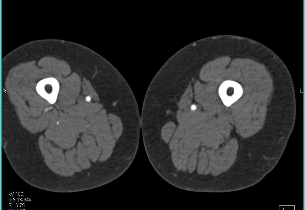 Normal CTA of the Lower Extremities for Pre-Op Planning - CTisus CT Scan