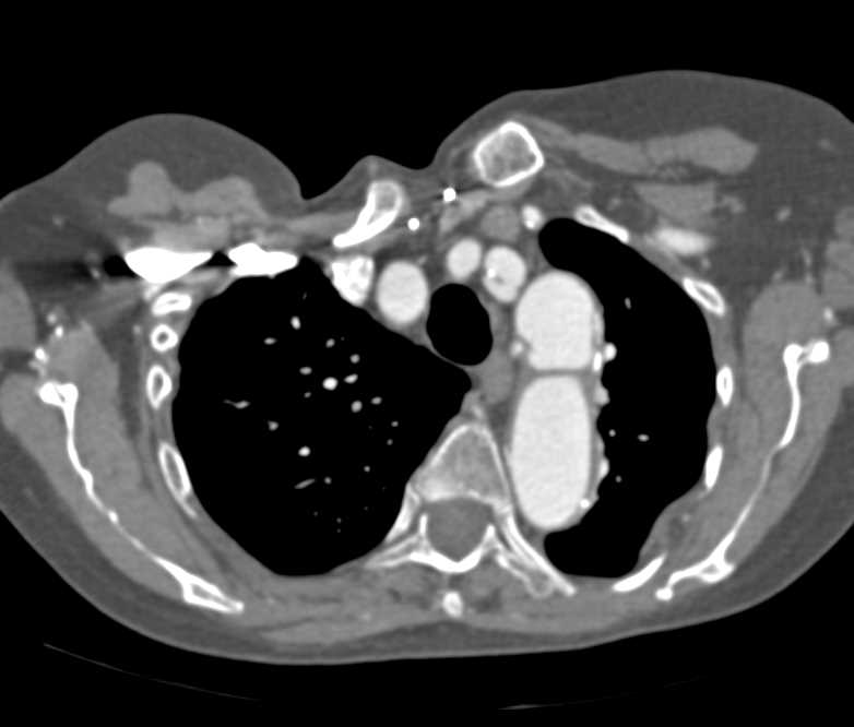 Aneurysms of the Intercostal Arteries - CTisus CT Scan