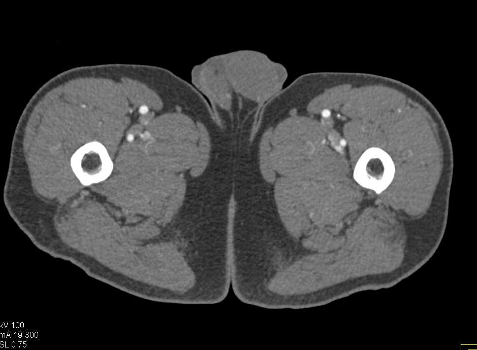 CTA Runoff with Dual Energy CT - CTisus CT Scan