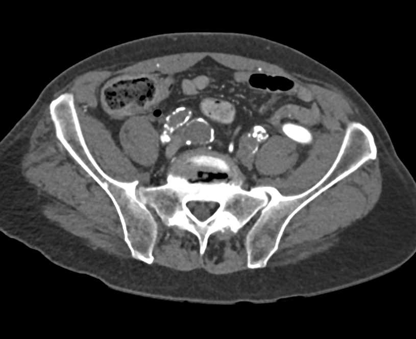 Fem-Fem Bypass Graft with Right Iliac Artery Occlusion and Peripheral Vascular Disease (PVD) - CTisus CT Scan