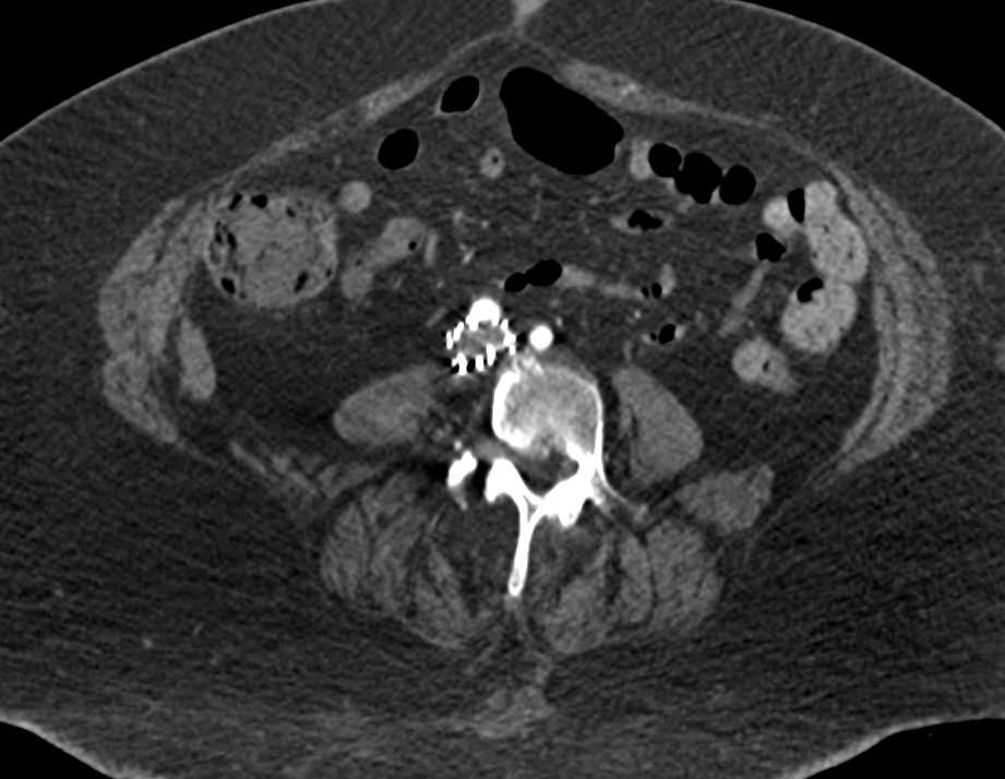 Complex Venous Stents for May-Thurner Syndrome (MTS) - CTisus CT Scan