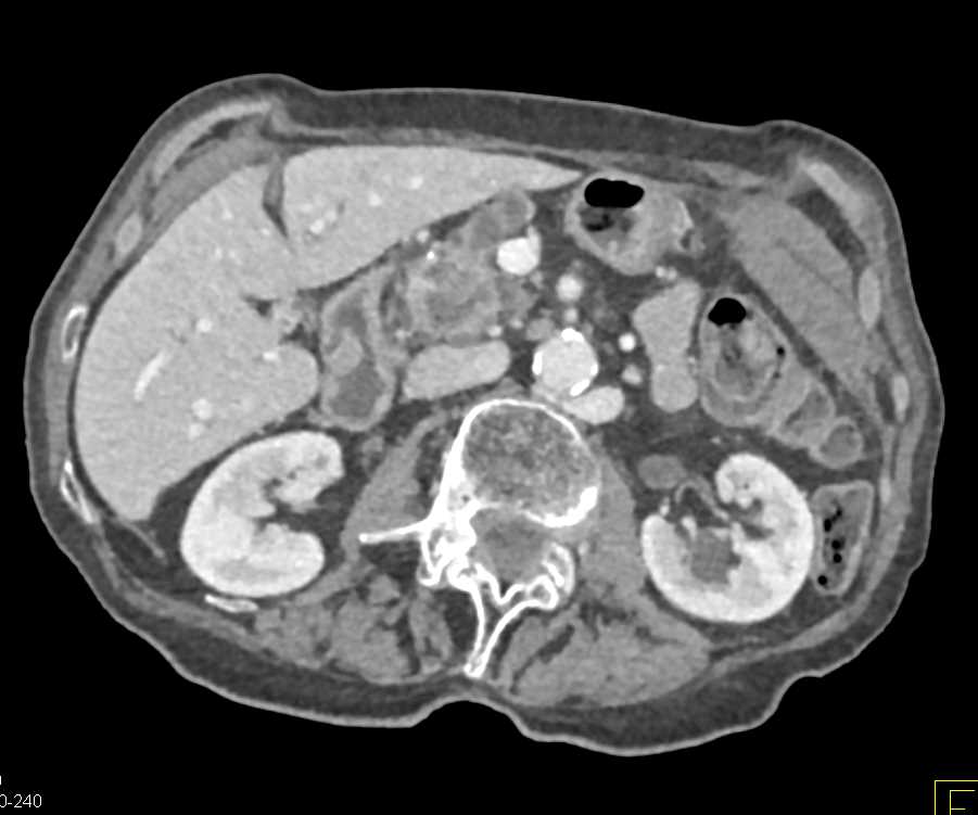 Displaced Inferior Vena Cava (IVC) Filter - CTisus CT Scan