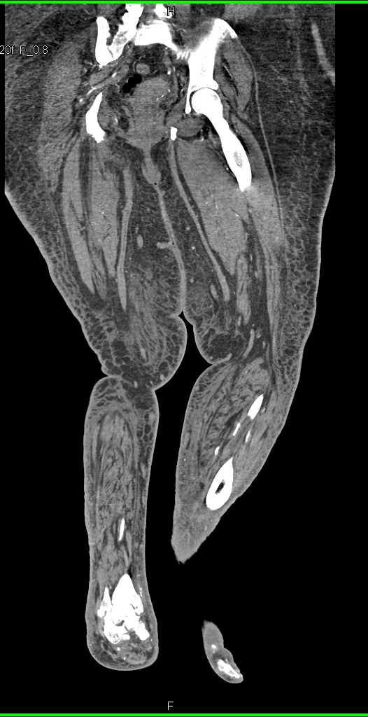 Peripheral Vascular Disease - CTisus CT Scan