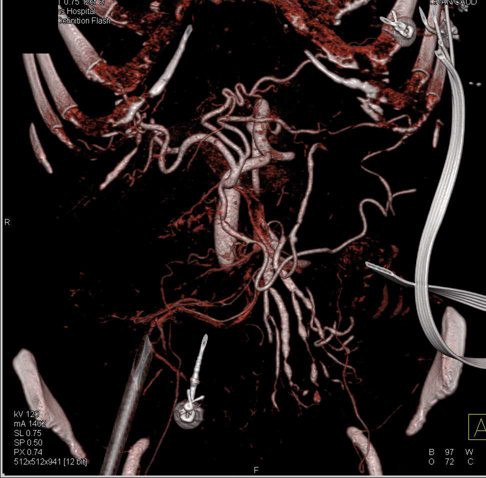 Vasculitis of Superior Mesenteric Artery (SMA) Branches - CTisus CT Scan