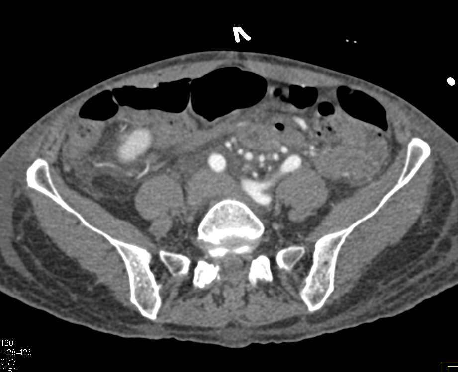 Vasculitis of Superior Mesenteric Artery (SMA) Branches due to Polyarteritis Nodosa - CTisus CT Scan