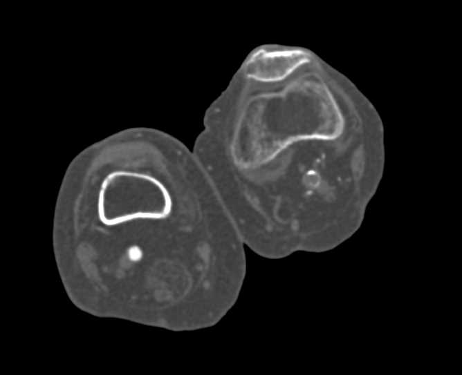 Extensive Peripheral Vascular Disease - CTisus CT Scan