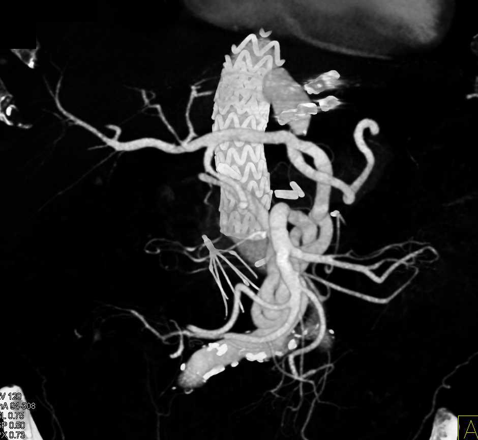 Endovascular Stent with Reimplantation of Mesenteric Arteries - CTisus CT Scan