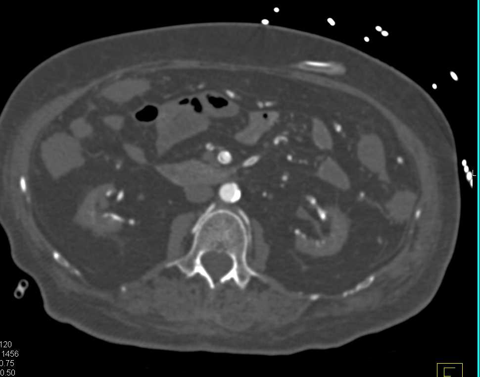 End Stage Renal Disease (ESRD) with Extensive Vascular Calcification in the Mesenteric Vessels - CTisus CT Scan