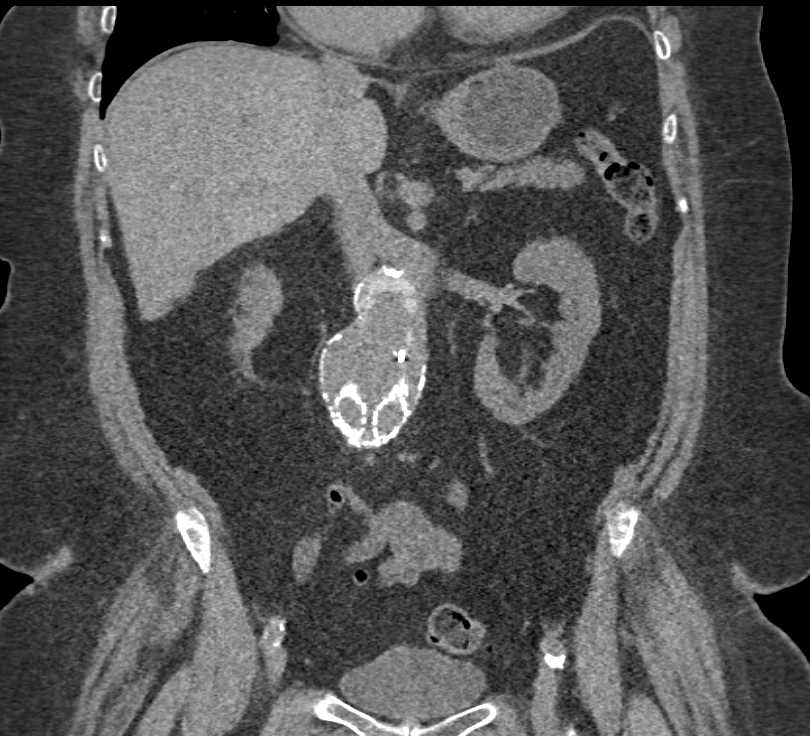 Endovascular Repair of Abdominal Aortic Aneurysm (AAA) - CTisus CT Scan