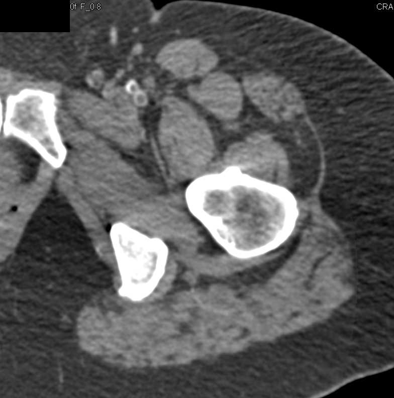 CTA Runoff with Occluded Superficial Femoral Artery (SFA) and Popliteal Artery - CTisus CT Scan