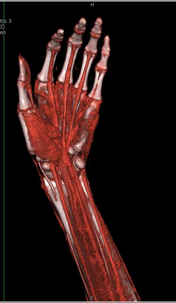 Radial Artery Occlusion - CTisus CT Scan