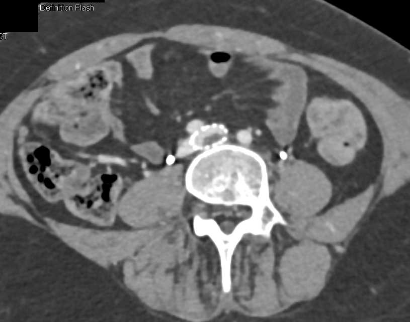 May-Thurner Syndrome (MTS) with Clot in Left Iliac Vein Stent Graft - CTisus CT Scan