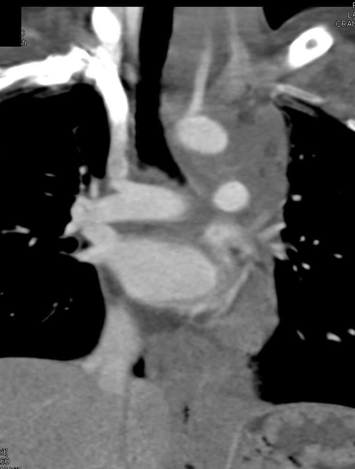 Aortic Dissection with Mediastinal Hematoma - CTisus CT Scan