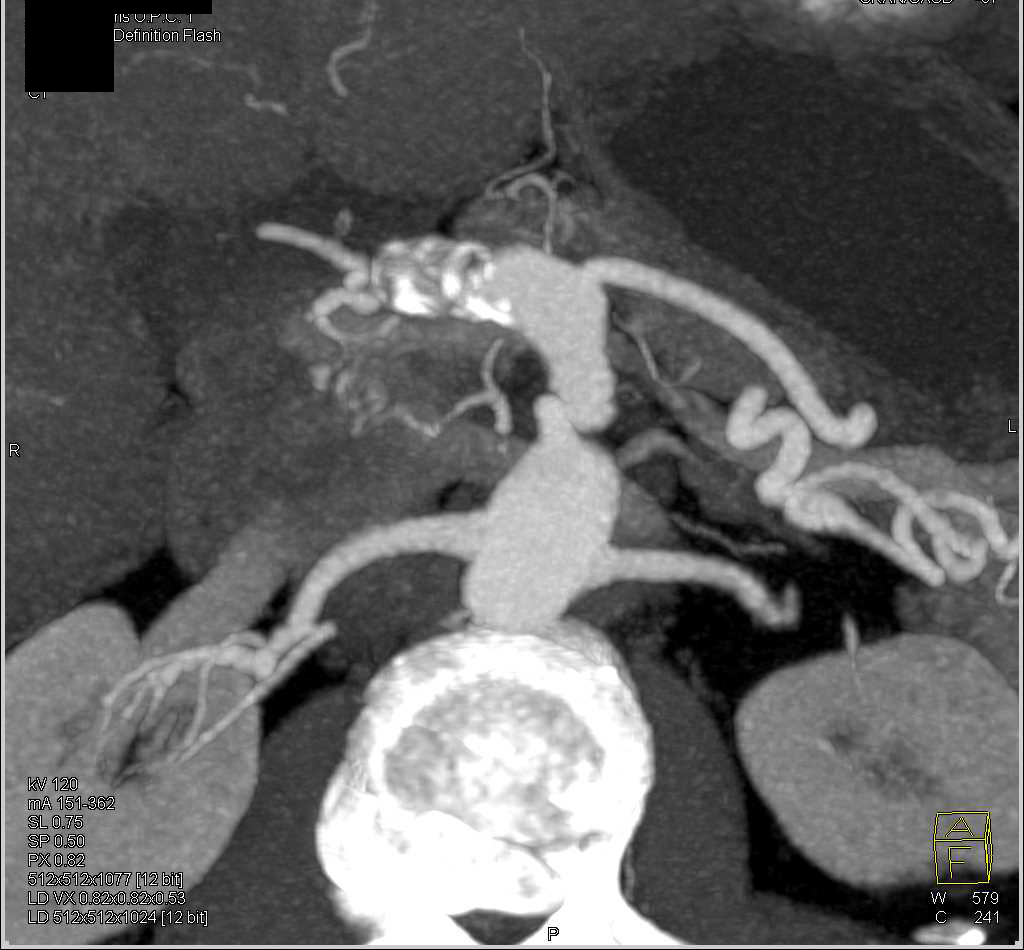 Calcified Hepatic Artery Aneurysm - CTisus CT Scan