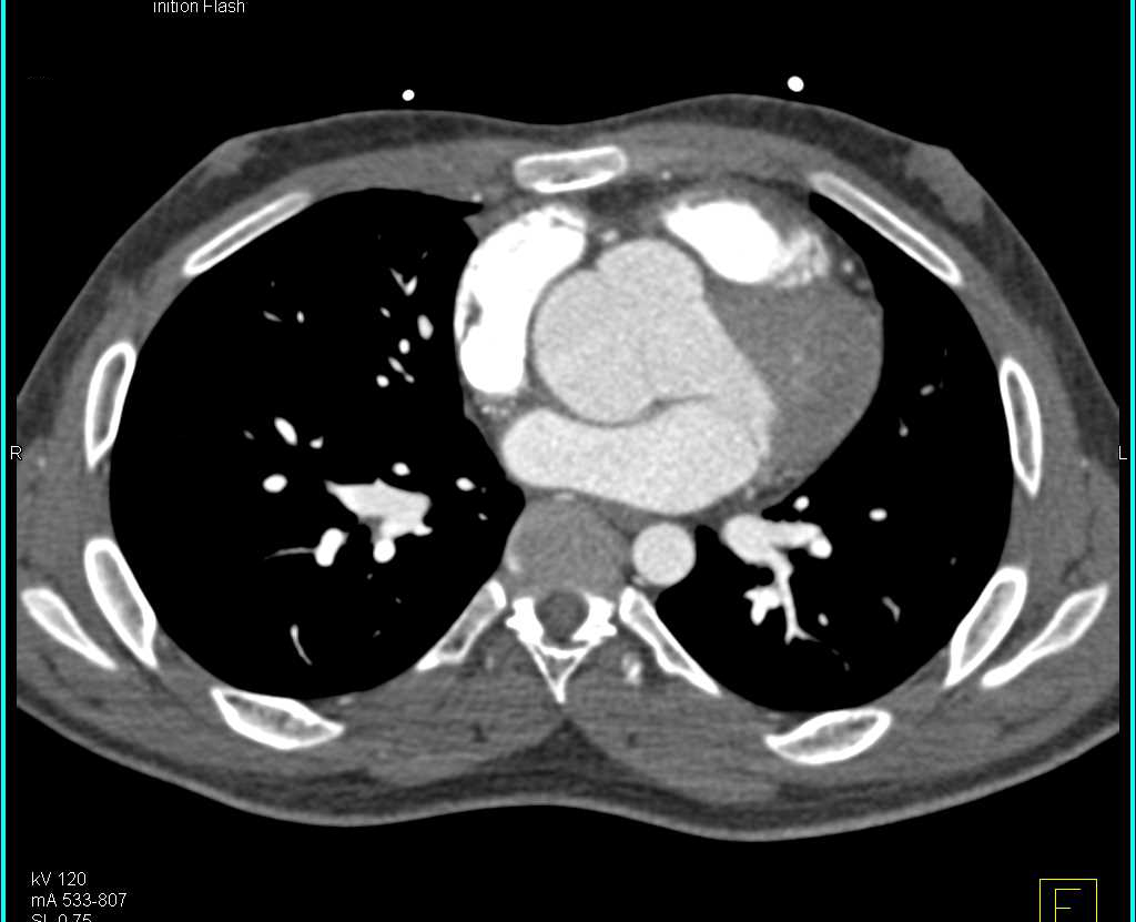 Dilated Aortic Root in Tulip Configuration in Patient with Marfan Syndrome - CTisus CT Scan