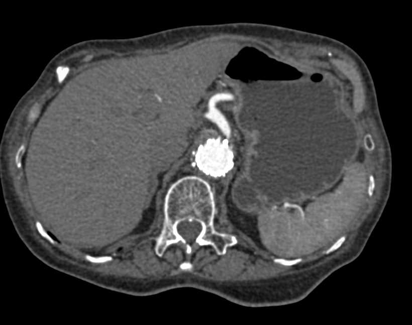 Endovascular Stent Repair and Graft to Superior Mesenteric Artery (SMA) - CTisus CT Scan