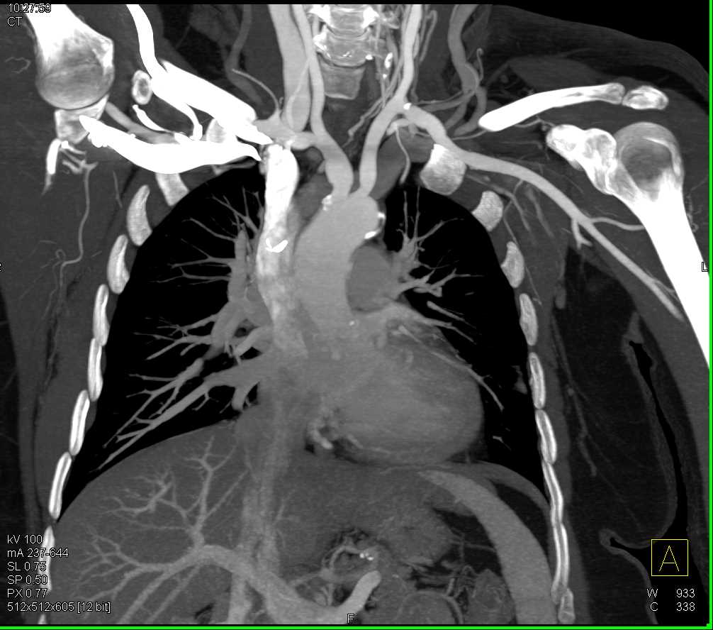 Takayasu's Arteritis with Occlusion of Left Subclavian Artery - CTisus CT Scan