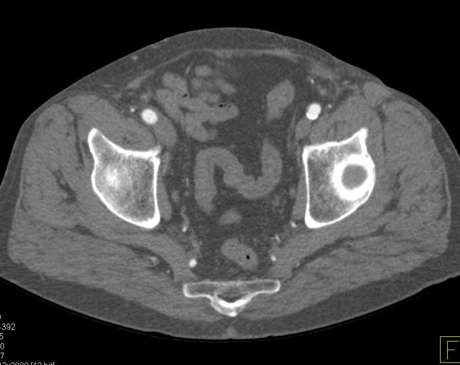 CTA Runoff with Occluded Left Posterior Tibial Artery - CTisus CT Scan