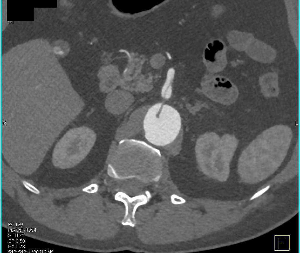 Dissection Tracks Into the Superior Mesenteric Artery (SMA) - CTisus CT Scan