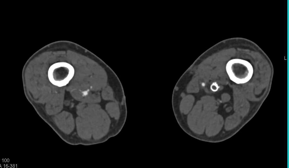 Occluded Left Vascular Stent with Good Three Vessel Runoff - CTisus CT Scan