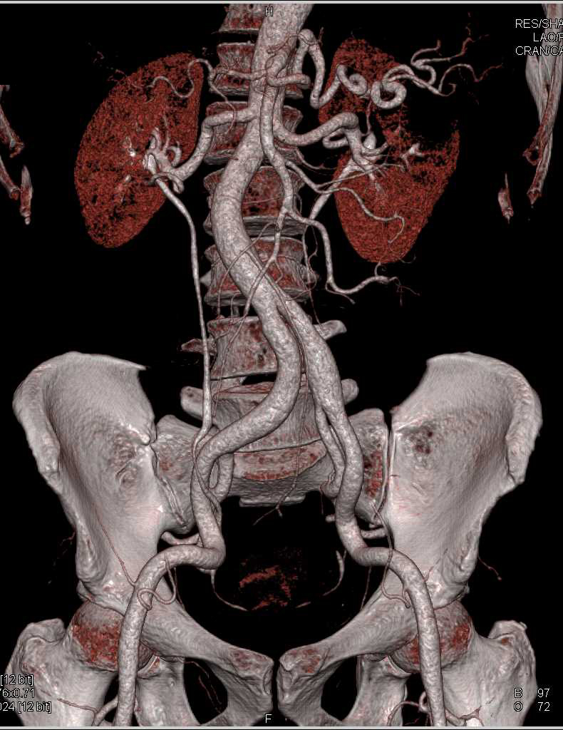 Focal Dissection of Celiac Artery - CTisus CT Scan