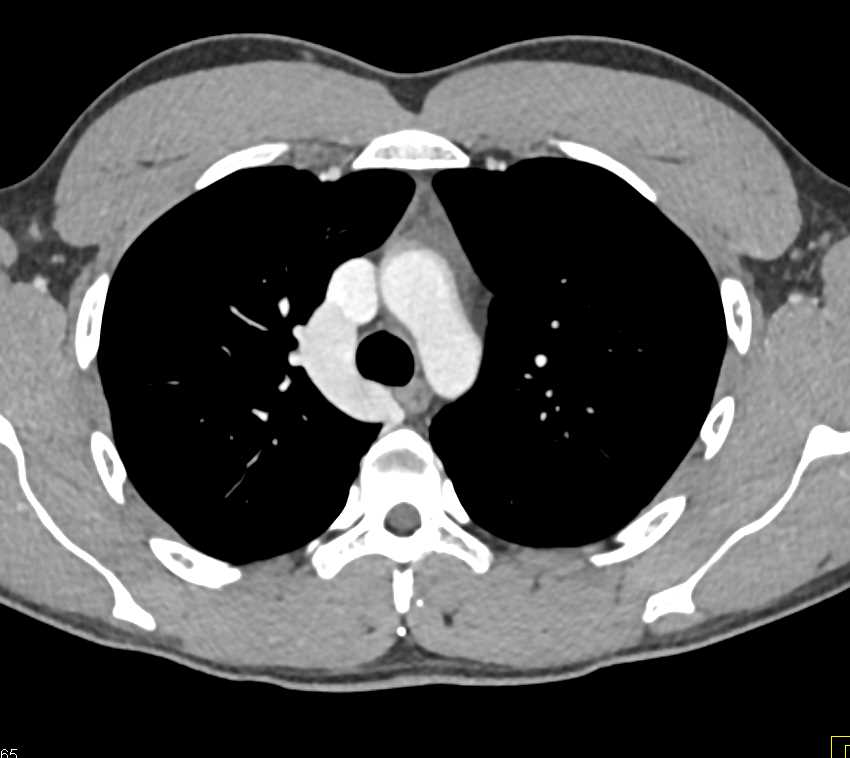 Prominent Azygos in Patient with May-Thurner Syndrome (MTS) - CTisus CT Scan