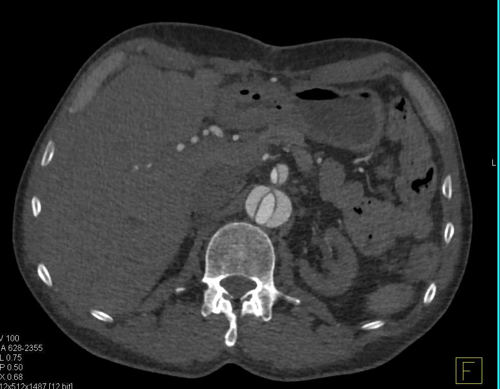 Aortic Dissection Involves the Superior Mesenteric Artery (SMA) - CTisus CT Scan