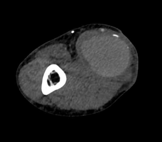 Pseudoaneurysm Just Above the Elbow off Brachial Artery - CTisus CT Scan