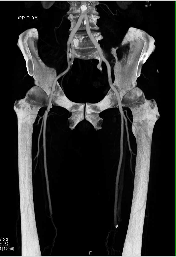 CTA Runoff Limited by Hardware for Total Knee Replacement - CTisus CT Scan