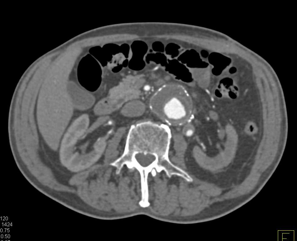 Pre-Operative Aortic Valvular Patient - CTisus CT Scan