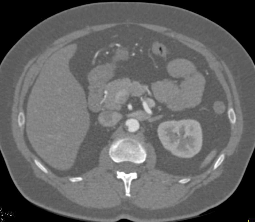 Thrombus Abdominal Aorta and Renal Arteries - CTisus CT Scan