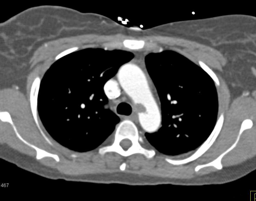 Thrombus in Descending Thoracic Aorta - CTisus CT Scan