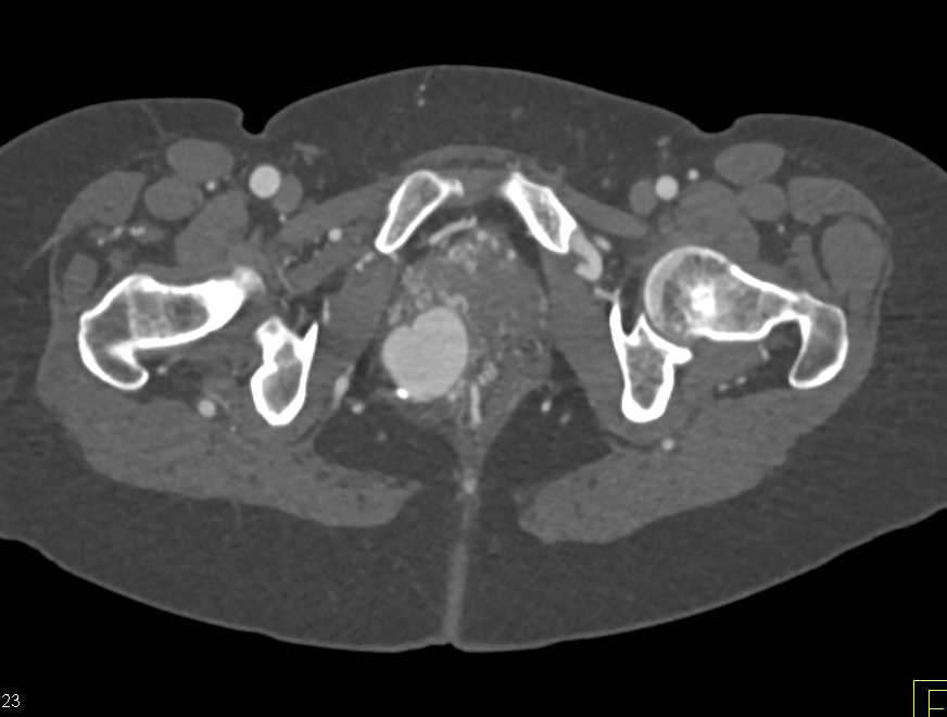 Pelvic Arteriovenous Malformation (AVM) with Embolization - CTisus CT Scan