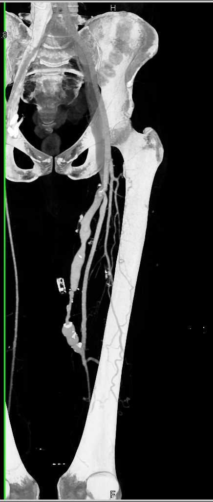 Stenosis with Arteriovenous (AV) Fistulae in the Thigh - CTisus CT Scan