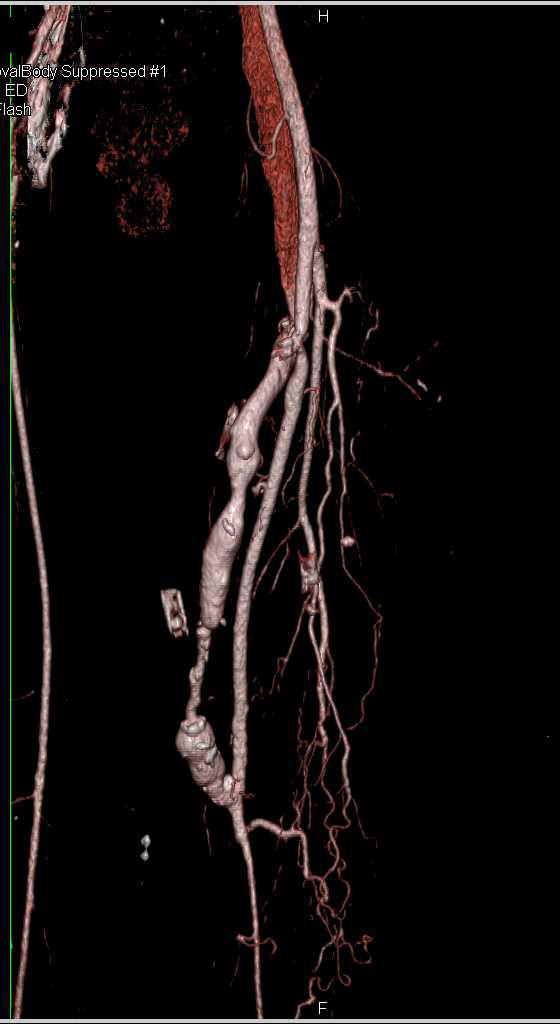 Stenosis with Arteriovenous (AV) Fistulae in the Thigh and Inferior Vena Cava (IVC) Occlusion with Collaterals - CTisus CT Scan