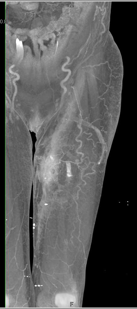 End Stage Renal Disease with Arteriovenous (AV) Fistulae in the Thigh - CTisus CT Scan