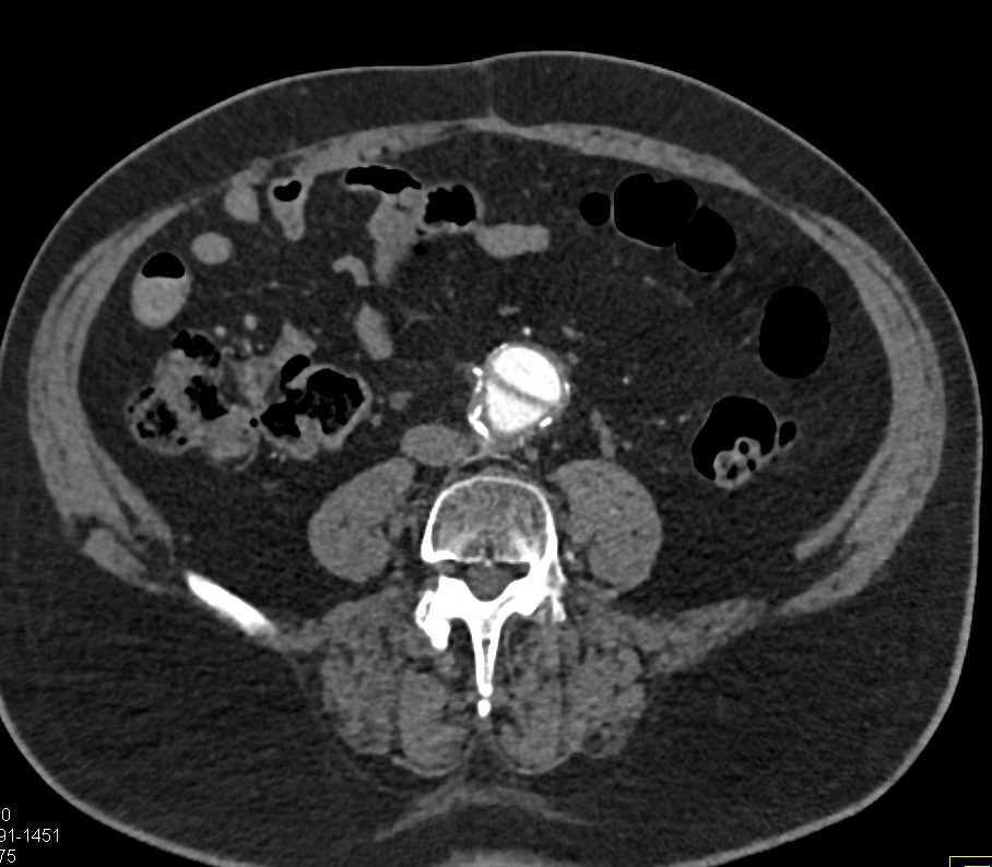 Pseudo-Dissection Aorta with Vascular Graft - CTisus CT Scan