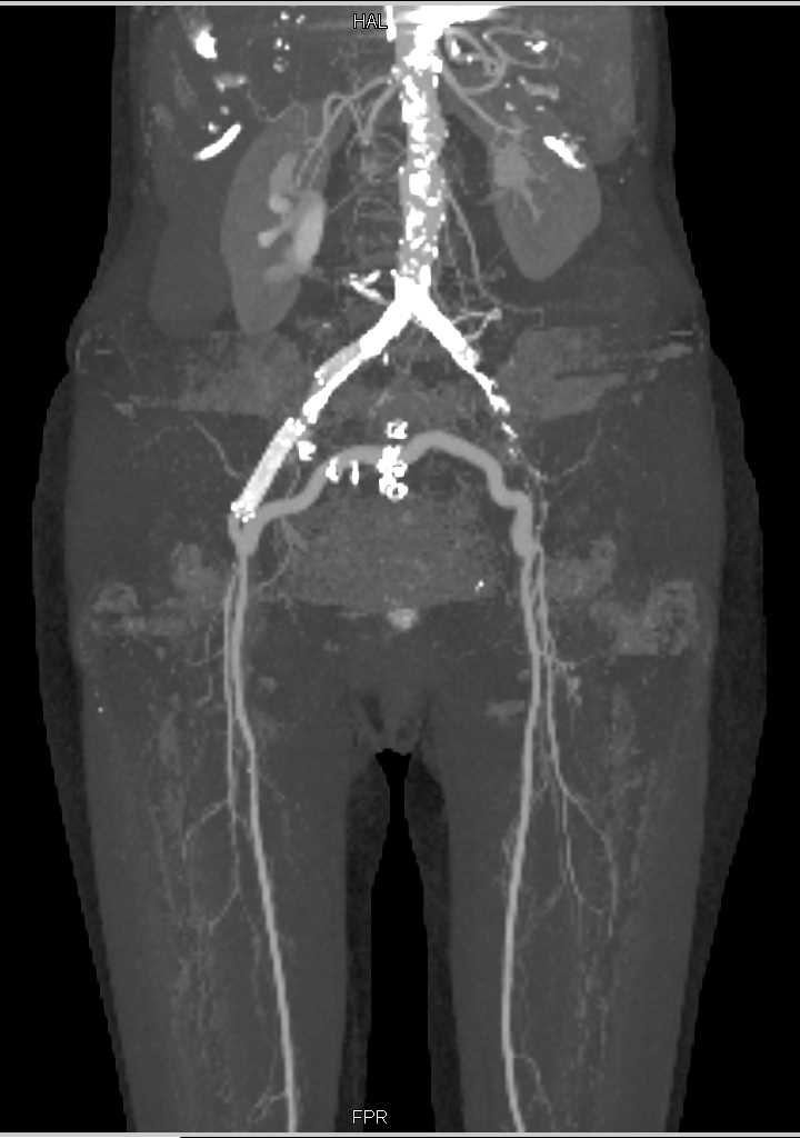 CTA with Peripheral Vascular Disease (PVD) and Fem-Fem Bypass Graft - CTisus CT Scan