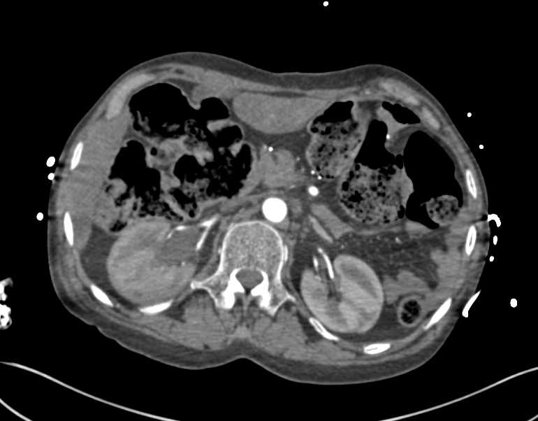 Leaking Graft with Large Right Lower Quadrant Bleed - CTisus CT Scan