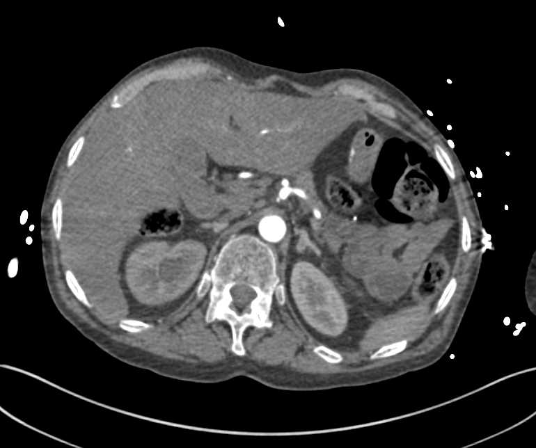 Leaking Graft with Large Right Lower Quadrant Bleed - CTisus CT Scan