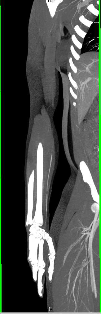 Radial Artery Occlusion - CTisus CT Scan