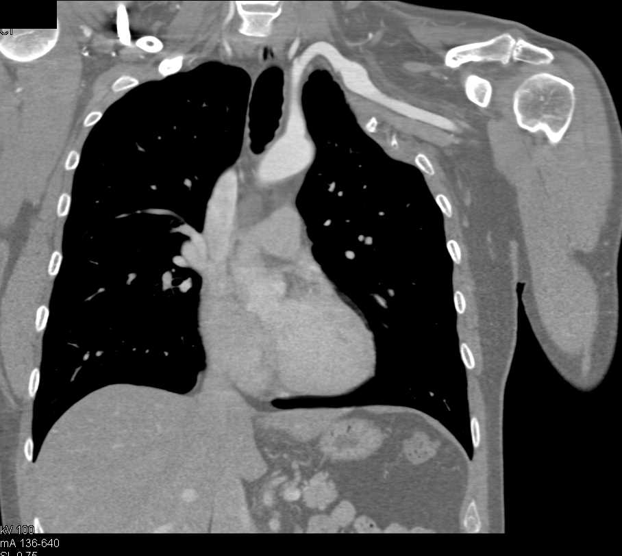 Left Axillary Artery  Aneurysm - CTisus CT Scan