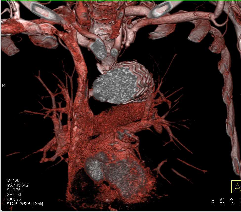 Endovascular Stent in Thoracic Aorta - CTisus CT Scan