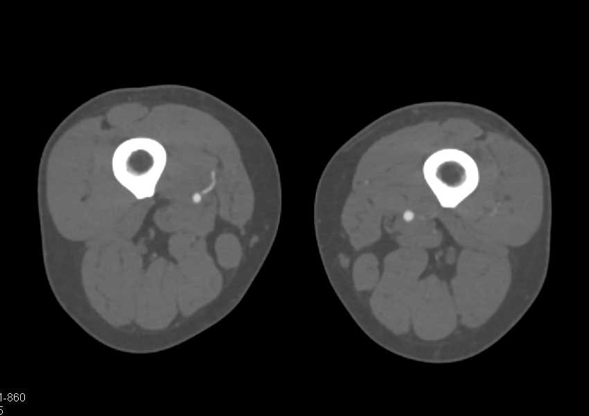 Peripheral Vascular Disease (PVD) with Edited Bone Images - CTisus CT Scan