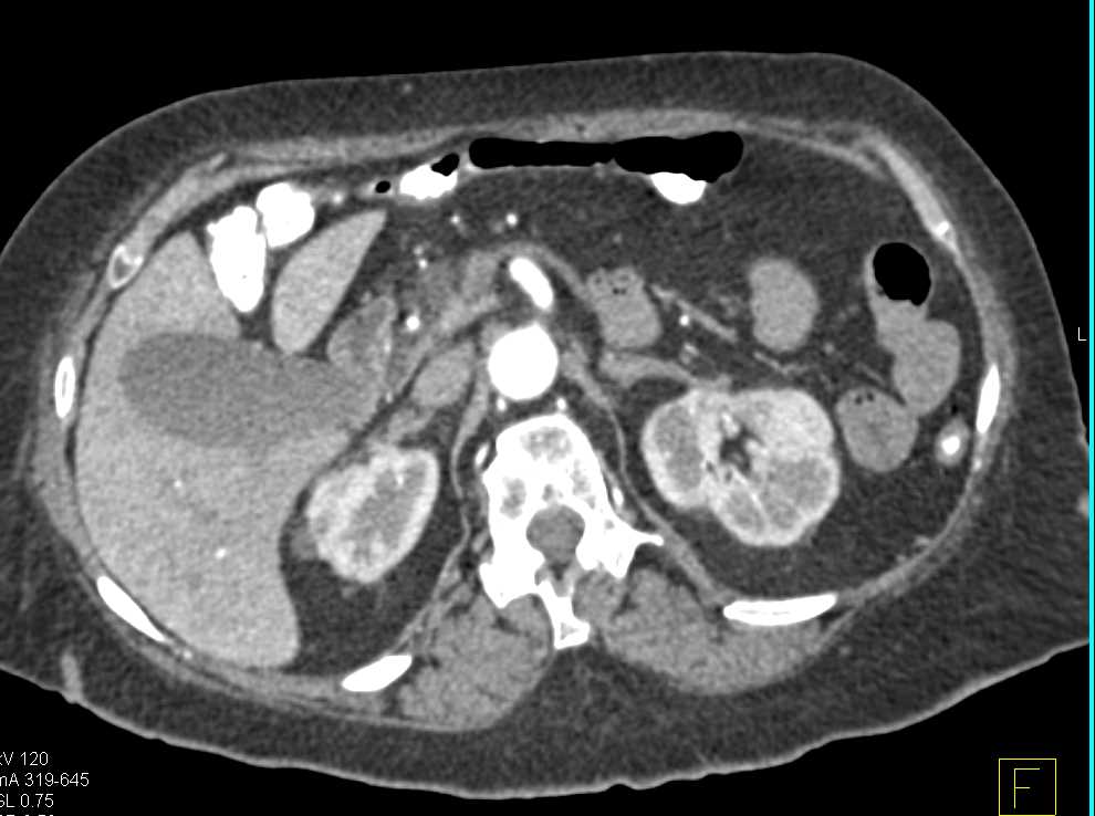 Bilateral Deep Vein Thrombosis (DVT) - CTisus CT Scan